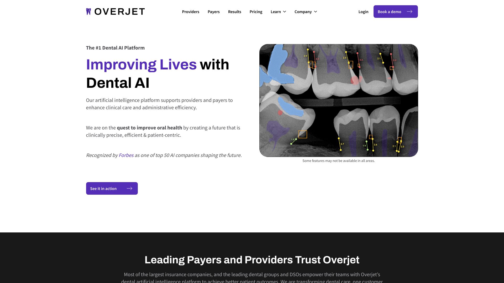 Overjet